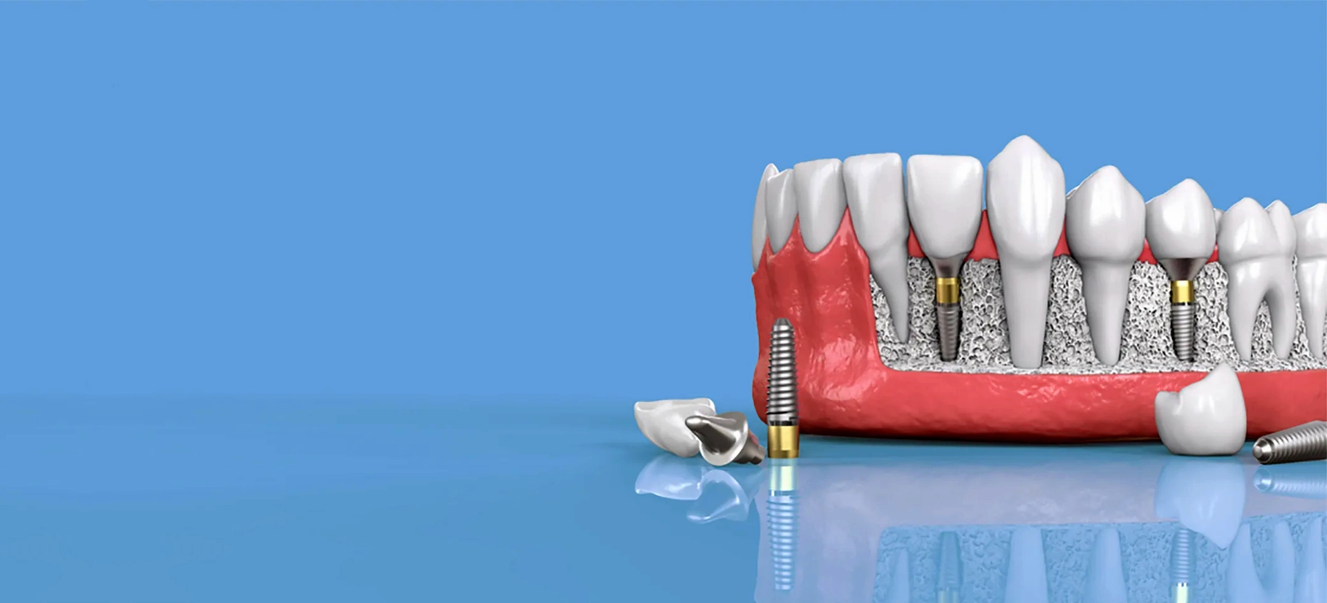 Dental İmplant Tedavisi